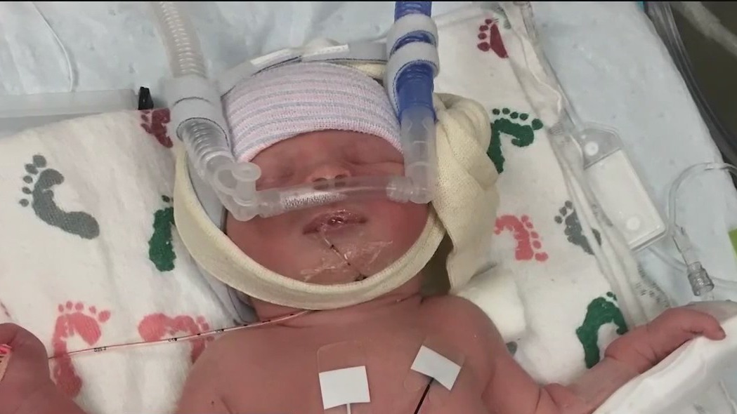 Florida baby born with large cranial defect flourishing 3 years later
